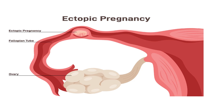 Ectopic, Ectopic Pregnancy, fallopian tube
